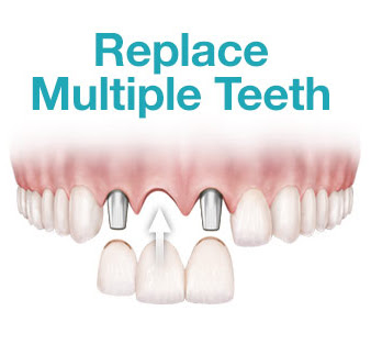 replace multiple teeth